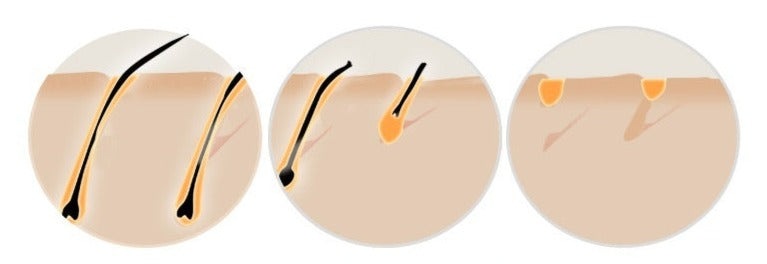 HexoSkin™ IPL-laserhårborttagningsenhet för hemmabruk
