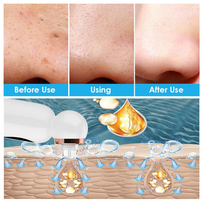 HexoSkin™ Hydrodermabrasion borttagare av pormaskar
