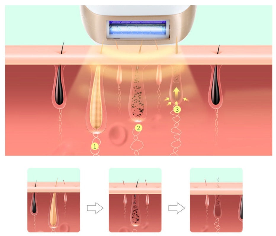 HexoSkin™ IPL-laserhårborttagningsenhet