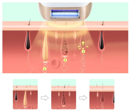 HexoSkin™ IPL-laserhårborttagningsenhet