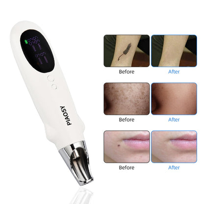 PIAOSY™ Pikosekundpenna för borttagning av tatuering, mörka fläckar och akneärr